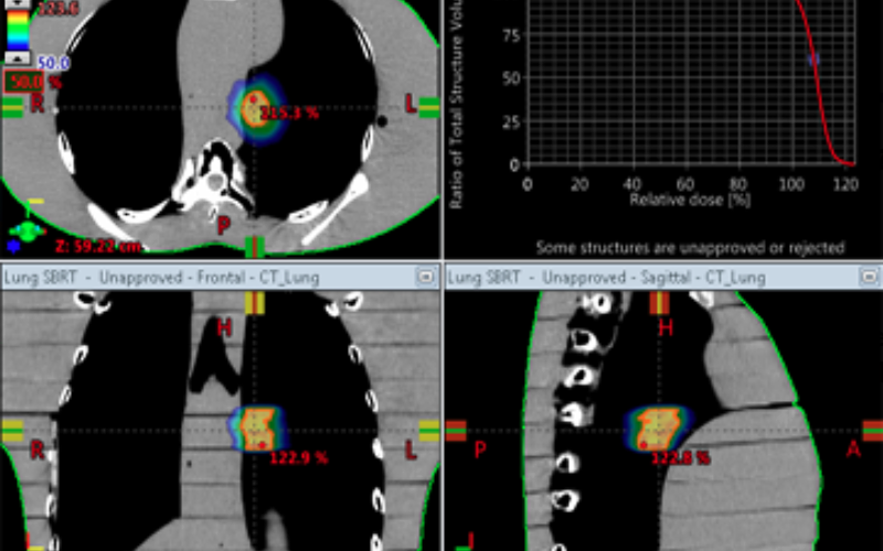 Tips & Tricks: Eclipse Conformity and Dose Spill Constraints