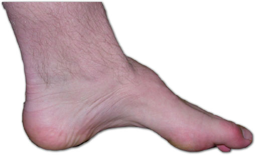 Aplasia cutis congênita