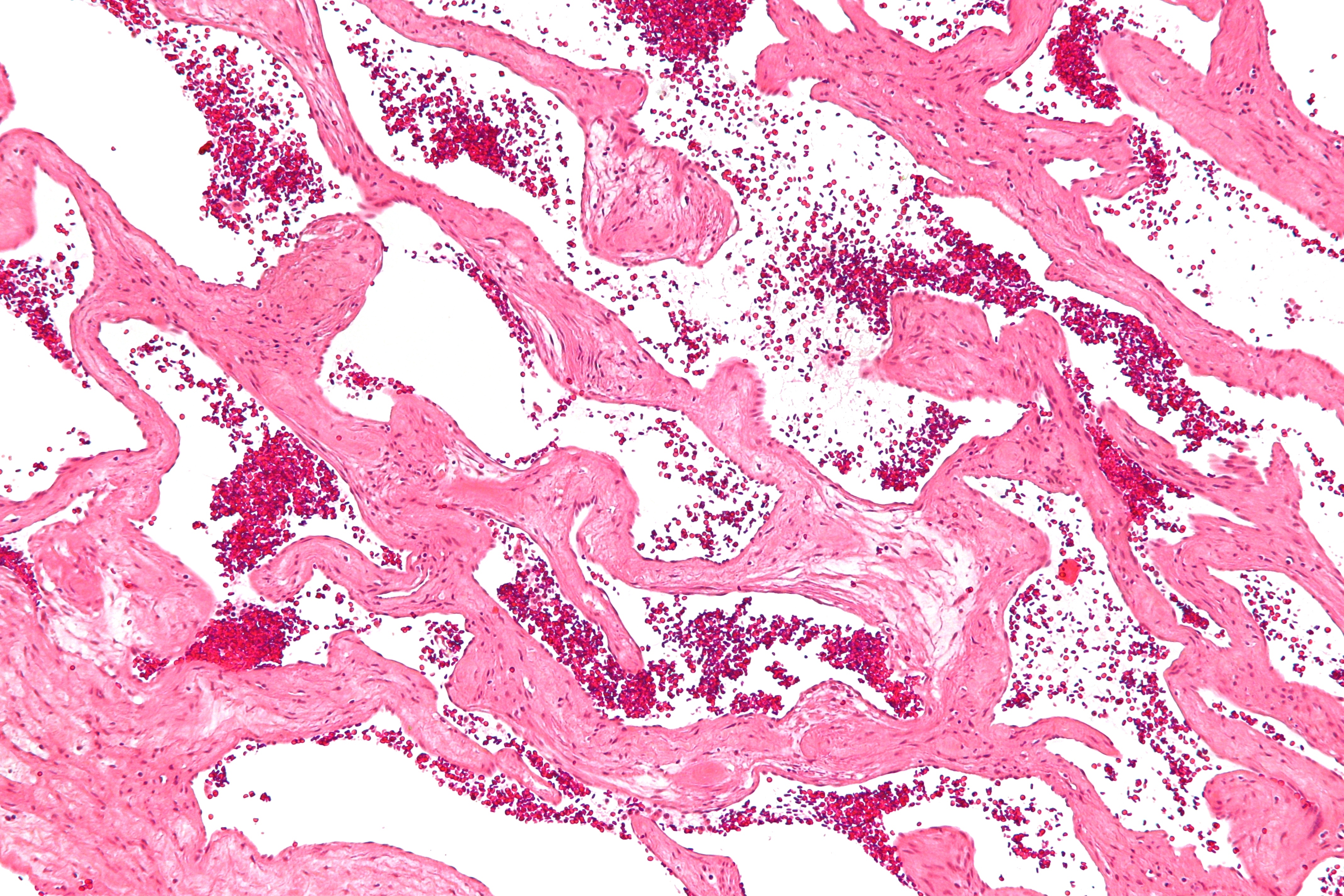 Malformação venosa — Sintomas, genes, diagnóstico e tratamento | Raras.org