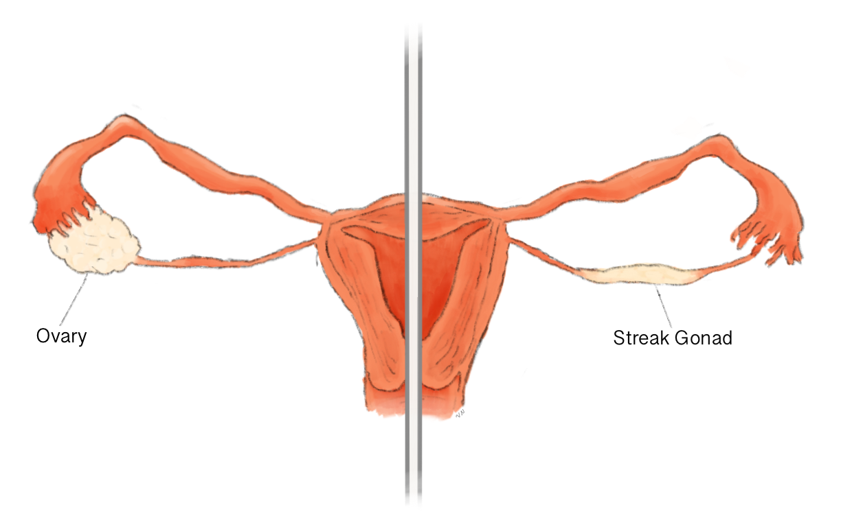 Síndrome de osteopenia-perturbação do desenvolvimento intelectual-cabelo rarefeito