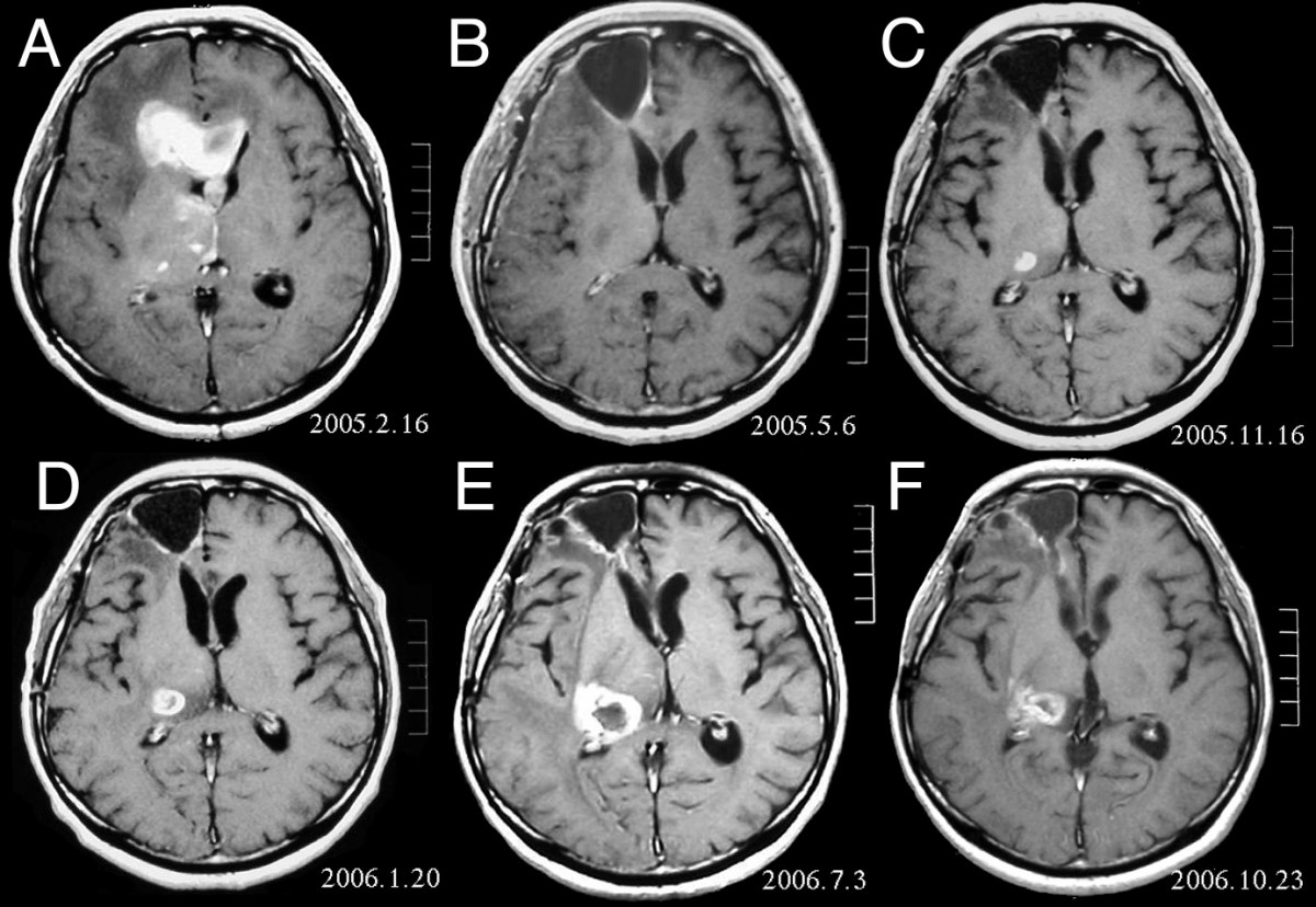 Tumor embrionário do tecido neuroepitelial