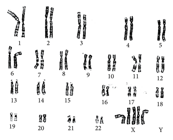Taurodontia