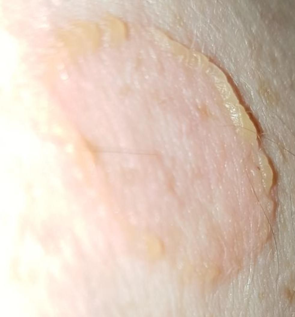 Dermatose por acúmulo linear de IgA