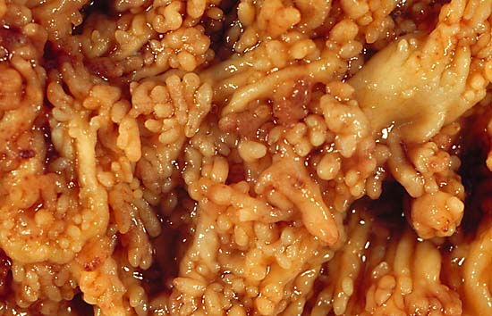 Colite ulcerosa