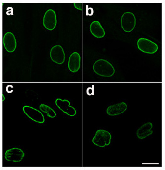 Laminopatia