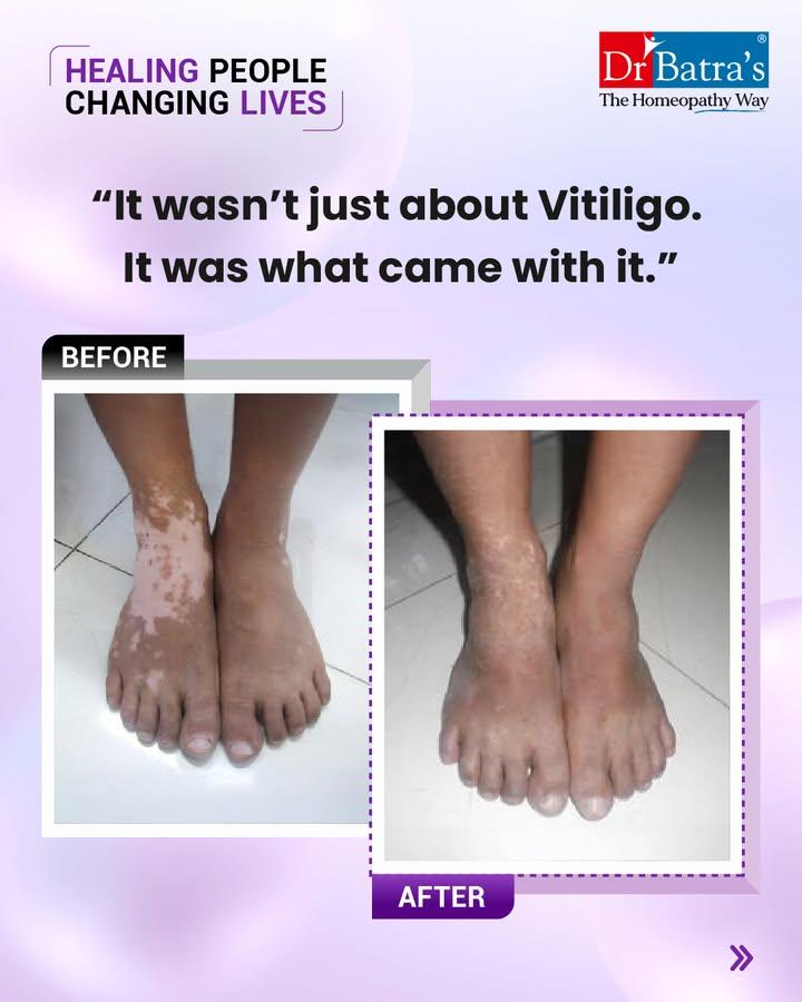 He was 58. Working in the private sector. On the outside, life looked stable.
But silently, he carried more than deadlines or check-ups.
Vitiligo had been spreading across his face, hands, and feet for years.
No itching. No pain. But it took something deeper—his confidence.
Every white patch reminded him of what he couldn’t control.
The glances he tried to ignore.
Why he avoided showing his hands in public.
On top of that came type 2 diabetes, hypertension, acidity, and the quiet weight of stress.

He followed the rules—took his medicines, tried lifestyle changes.
But life felt like a checklist:
✔️ Pills for BP
✔️ Sugar monitoring
✔️ Avoiding the mirror

He tried creams. Suggestions. Hopes. The patches stayed.
And inside, the silence grew louder.

Then something changed.
Not a miracle—just a decision to try again, differently.

His healing began with:
🌿 Individualised homeopathy—for skin and overall health
💧 Dermaheal sessions to support pigmentation
🥗 Gentle diet changes
🚶‍♂️ Daily walks he could stick to
Slowly, change came.
✨ The patches started blending in
✨ No new patches for over 2 years
✨ Hands looked healthier
✨ Diabetes & BP stabilised
✨ Acidity reduced
✨ And something unexpected returned: pride

“I feel like myself again,” he shared.
Not because everything’s perfect—but because he no longer hides.
Healing isn’t always about perfection.
It’s about progress. About reclaiming what felt lost.
Vitiligo didn’t just affect his skin.
It tested his strength.
And step by step—he took it back.

#AbJeetoJaddSe

📞 Call: +91 91671 91671
🌐 Book now: drbatras.com/skin-diseases/vitiligo-treatment-in-homeopathy
📲 Follow @drbatras_healthcare for real recovery stories & hope.

#HealingPeopleChangingLives #DrBatras #DrBatrasHealthcare #Vitiligo #VitiligoRecovery #FromInvisibleToConfident #HealingFromWithin #SkinJourney #HomeopathyForVitiligo #TheHomeopathyWay #ThaneClinic