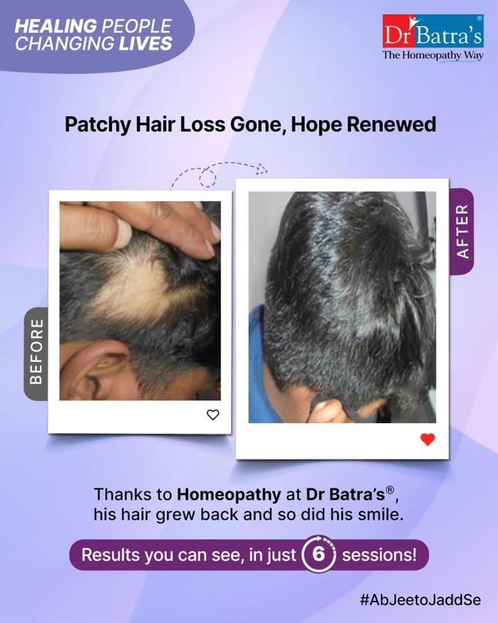 #HealingPeopleChangingLives

🌿 Hair Lost to Stress. Hope Found at Dr Batra’s®. 🌿

When life became overwhelming, stress didn’t just weigh on his mind — it showed on his scalp.
Two bald patches appeared suddenly within a month. He felt anxious, confused, and his confidence began to fade.

At Dr Batra’s® Clinic, Salt Lake, Kolkata, he found more than just answers.
With personalized care and the gentle power of homeopathy, his healing journey began — naturally, holistically, and from within.

🌱 Homeopathy healed him from the root.
His hair grew back. His smile returned. And with it, his strength.

Because at Dr Batra’s®, we understand — healing goes deeper than just the surface.
#AbJeetoJaddSe

📞 Call +91 91671 91671 or visit to book your consultation at Dr Batra’s® Clinic.
Follow @drbatras_healthcare for more inspiring stories of transformation. 💙

#DrBatras #DrBatrasHealthcare #TheHomeopathyWay #SaltLakeClinic #HomeopathyForHair #StressHairLoss #HairRegrowth #HealingFromTheRoot #ConfidenceRestored #PatchyHairLoss
