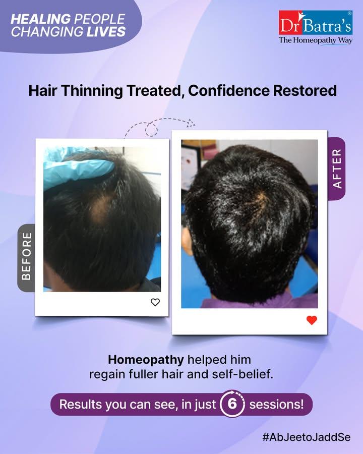 💫 He Lost Hair, Not Hope

A young man walked into Dr Batra’s Bhopal Clinic carrying more than just visible hair loss — he carried the weight of stress, bald patches, and fading self-worth.

Through homeopathy and aesthetic care, his journey slowly transformed.
His hair began to return… but more importantly, so did his confidence, his smile, and his belief in himself.

Because healing is not just about what’s seen — it’s about what’s felt. 💖

#HealingPeopleChangingLives #DrBatras #DrBatrasHealthcare #TheHomeopathyWay #ConfidenceRestored #HairRegrowthJourney #HomeopathyHealing #YoungManStory #BhopalClinic #EmotionalRecovery