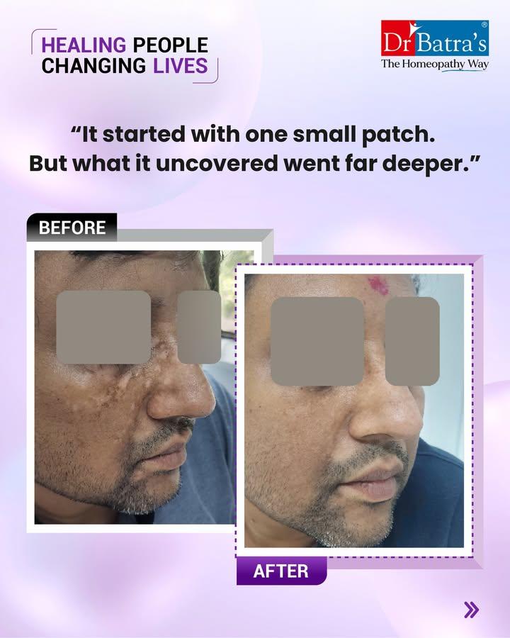 At 43, his skin began telling a quiet story.
What started as a small white patch slowly spread across his face. Treatments brought temporary relief, but the moment he stopped, the patches returned.

Beneath the surface, years of stress and unspoken emotions had built up—work pressure, constant adjusting, never truly feeling heard. On the outside, he looked stable. On the inside, he carried restlessness.

Healing began not just with medicines, but with a whole approach:
✨ Homeopathy to calm inner anxiety
✨ Gut and immune support for balance
✨ A nourishing, anti-inflammatory diet
✨ Emotional release tools to help him reclaim his voice

And slowly, change unfolded…
🌱 White patches slowed down
🌱 Pigment began to return
🌱 Sleep and digestion improved
🌱 A sense of calm replaced restlessness
🌱 Confidence started to rebuild

Vitiligo wasn’t just about his skin—it was a sign of his hidden struggles.
Now, as he heals within, his skin is learning to heal too.

💛 True healing is always inside out.
#AbJeetoJaddSe

📞 Call: +91 91671 91671
🌐 Book now: drbatras.com/skin-diseases/vitiligo-treatment-in-homeopathy
📲 Follow @drbatras_healthcare for real recovery stories & hope.

#HealingPeopleChangingLives #DrBatras #DrBatrasHealthcare #Vitiligo #VitiligoHealing #TrueHealingInsideOut #MindSkinLink #EmotionalHealing #AutoimmuneCare #FromInvisibleToSeen #TheHomeopathyWay #VitiligoSupport #ThaneClinic