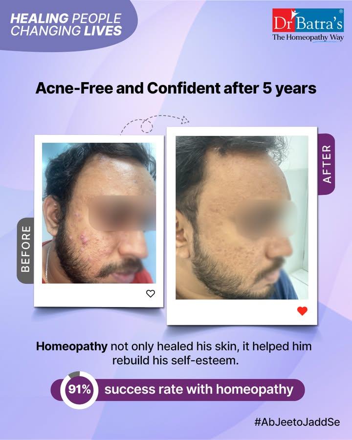 #HealingPeopleChangingLives 🌿✨

A young man suffering from cystic acne—a severe and painful skin condition that causes deep, inflamed cysts came to Dr Batra’s® Viman Nagar Clinic, Pune, in search of relief.

Since 2016, cystic acne had been his constant battle—each painful bump a reminder of lost confidence 💔 and dreams put on hold.

 For years, he felt like his skin told a story—one of pain, struggle, and hiding from the world.

But today, his skin tells a new story—one of healing, hope, and strength 💪✨. His acne has cleared, but more importantly, his smile is back, and so is his confidence 😊💫.

 If you or someone you know is facing a similar struggle, remember—help and healing are possible 🌸. Let us walk this journey with you.

 📞Call +91 91671 91671 or visit to book your consultation at Dr Batra’s® Clinic.
 Follow @drbatras_healthcare for more inspiring stories of transformation 💙.
.
.
#DrBatras #DrBatrasHealthcare #TheHomeopathyWay #Acne #CysticAcne #HomeopathyHealing #AcneRelief #SkinAilment #SkinTreatment