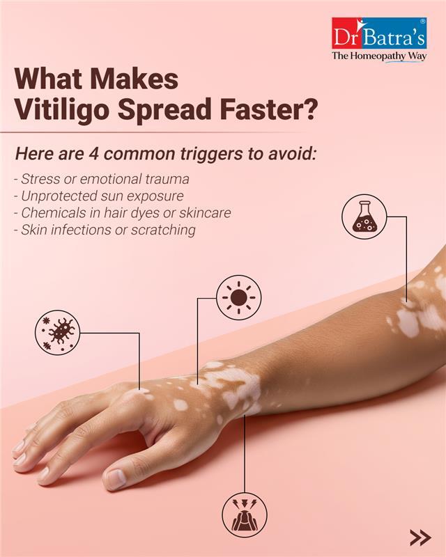Vitiligo can be unpredictable — but the right awareness and care can slow its spread. 💡
From stress to skin injuries, certain vitiligo triggers may worsen the condition over time. Knowing them is the first step to protecting your skin.

At Dr Batra’s®, our homeopathic treatment for vitiligo offers safe, customised care that helps your skin heal from within — gently, naturally, and effectively. 🌿

🩺 Early action matters.
📞 Book your consultation: +91 91671 91671
🌐 https://www.drbatras.com/skin-diseases/vitiligo-treatment-in-homeopathy
.
.
#DrBatras #DrBatrasHealthCare #DrBatrasCare #Vitiligo #VitiligoTreatment #VitiligoAwareness #HomeopathyForSkin #SkinDisorders #NaturalSkinCare #HolisticHealing #SkinHealth #VitiligoSupport #SkinCareThatHeals #HomeopathicTreatment #TimelyIntervention #AbJeetoJaddSe #HealthySkinNaturally #TheHomeopathyWay
