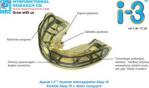Aparat MRC i-3n bez szyny trainer miękki Elastyczny aparat ortodontyczny ortho
