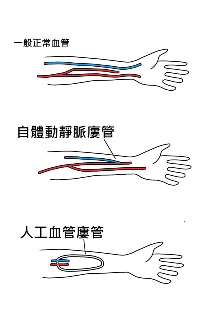 洗腎用自體動靜脈廔管與人工血管廔管示意圖