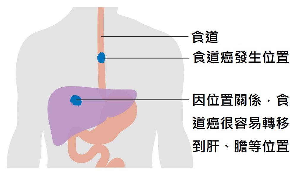 食道癌