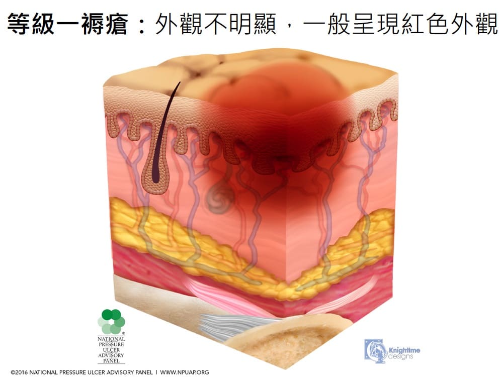 等級一褥瘡