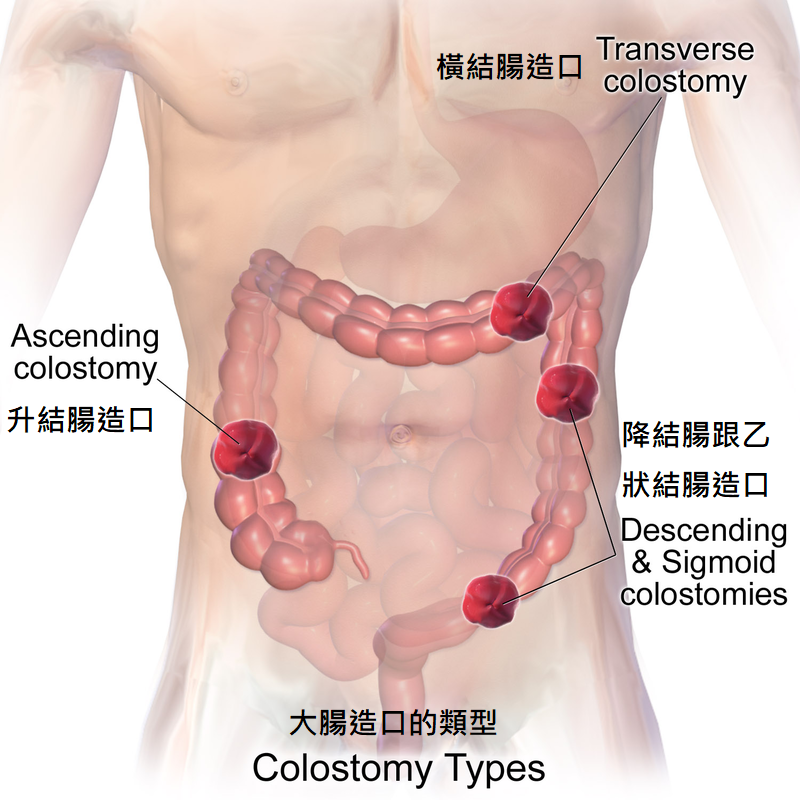 大腸造口的類型