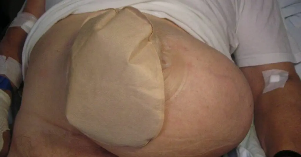 照顧大腸造口
