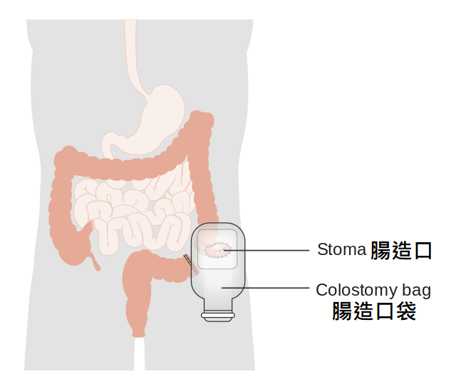 大腸造口