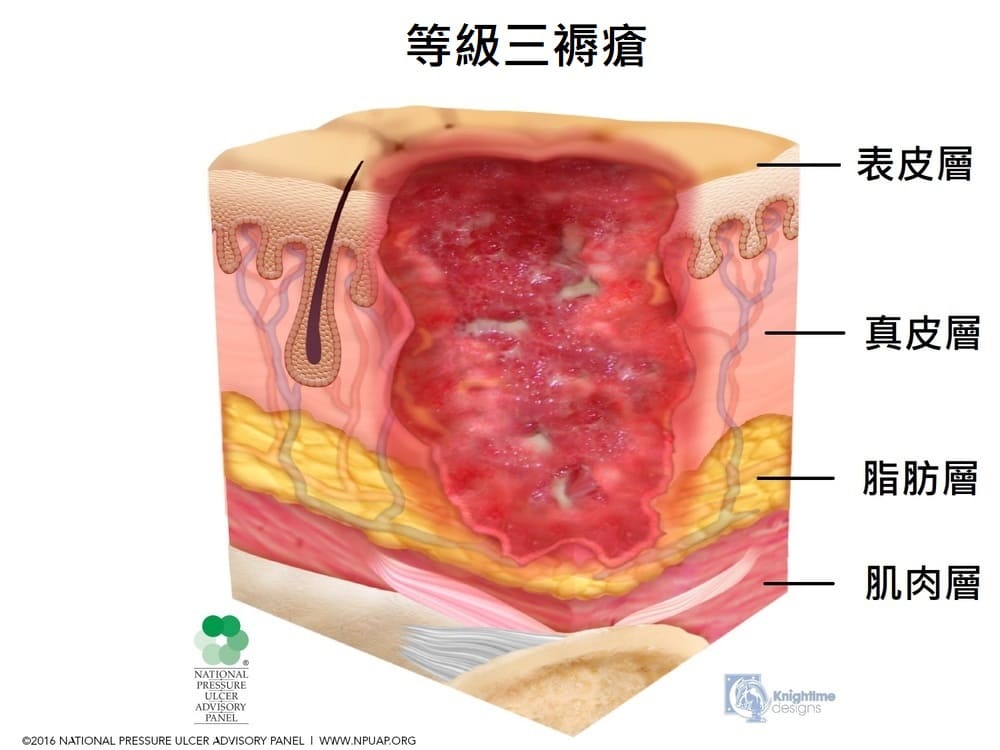 等級三褥瘡