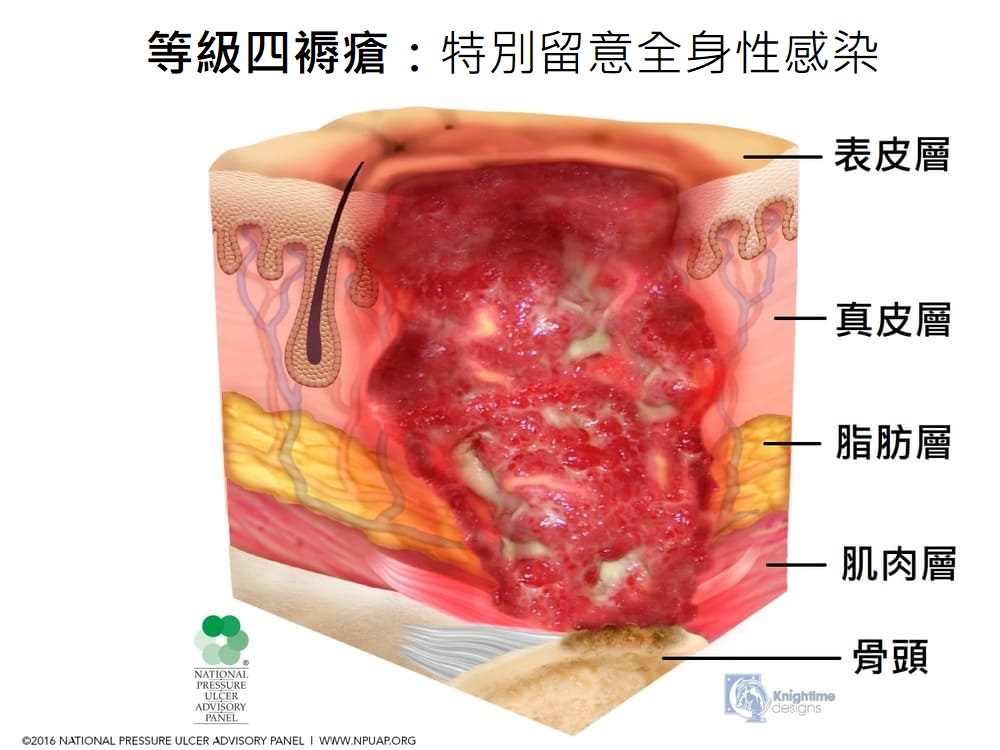 等級四褥瘡