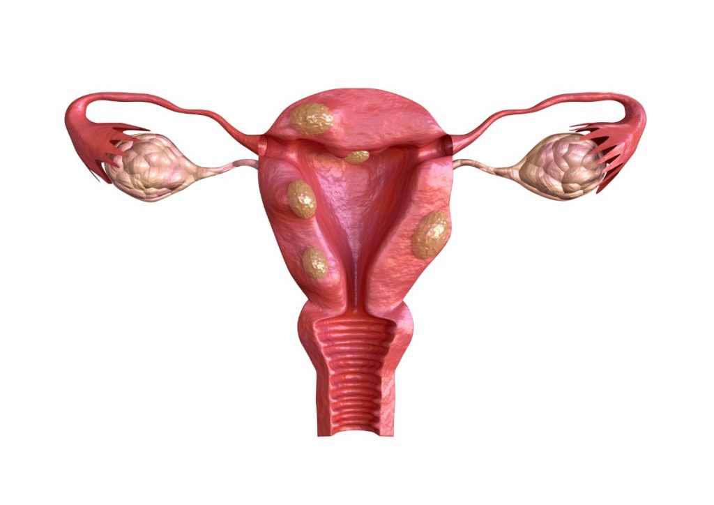 Mioma uterino