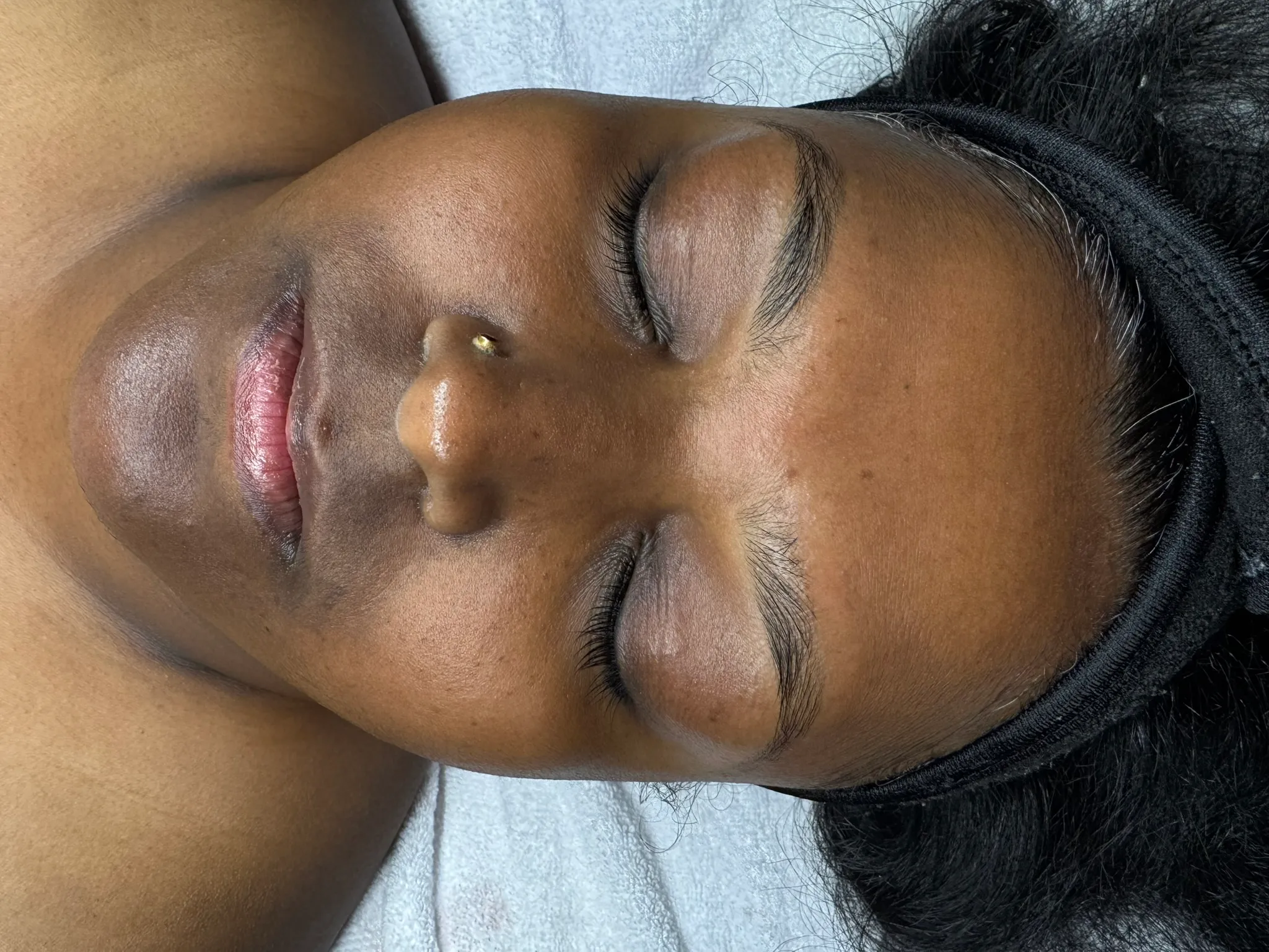 HydraFacial Overview