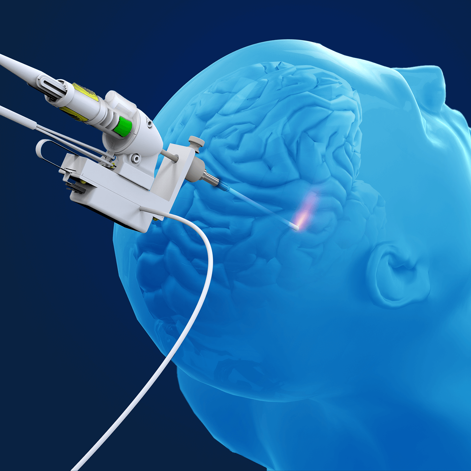Робот Monteris Medical NeuroBlate