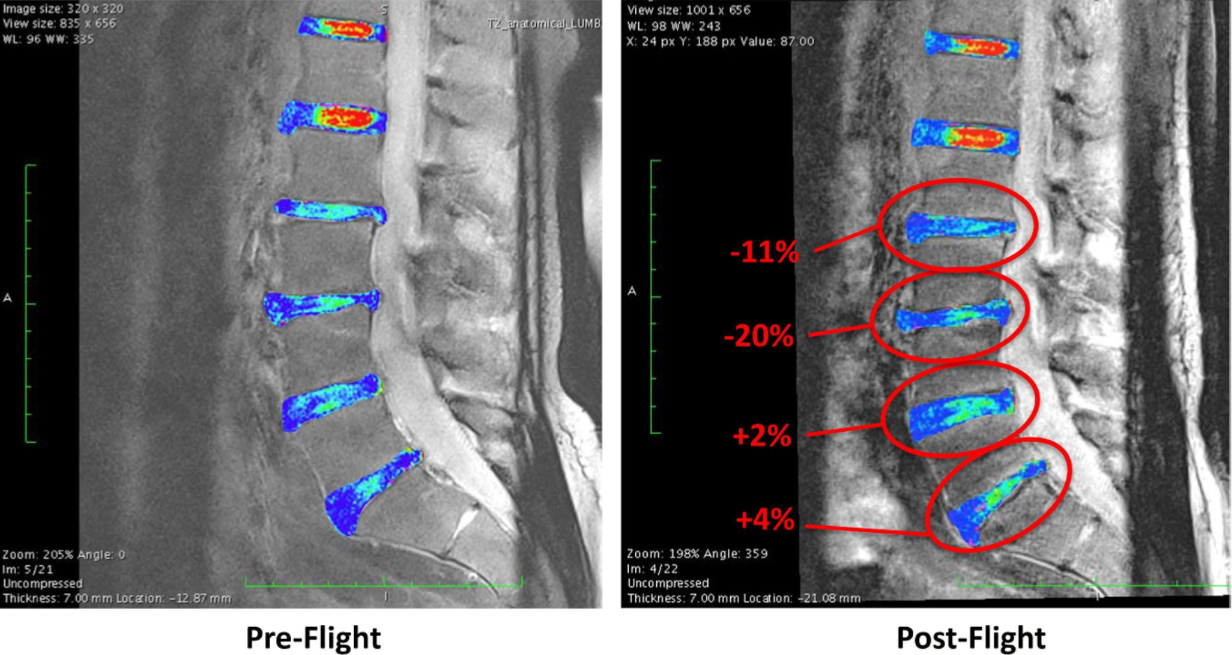 A recent space station study found that the astronauts who showed increased asymmetry between right and left back muscle composition, differences between spinal segments, and drastic changes in quality and structure of the muscles between preflight and postflight also reported more back pain. 