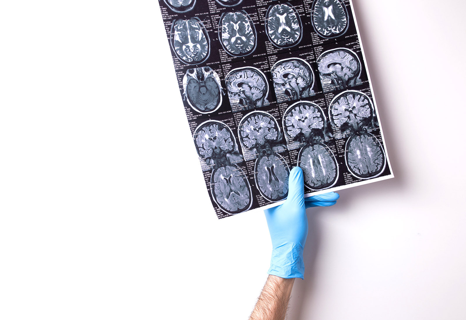 Terapi Endovaskular Invasif Minimal untuk Penanganan Stroke