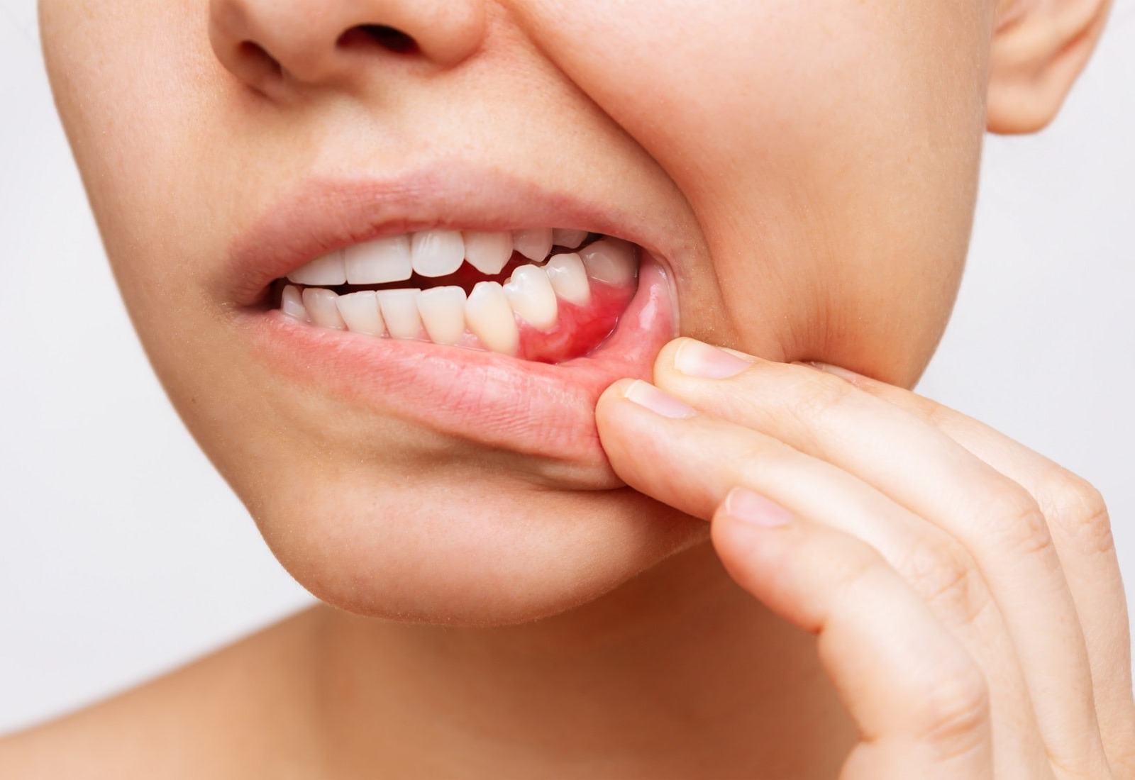 Kenali Gejala Periodontitis, Masalah Gusi yang Tak Bisa Disepelekan