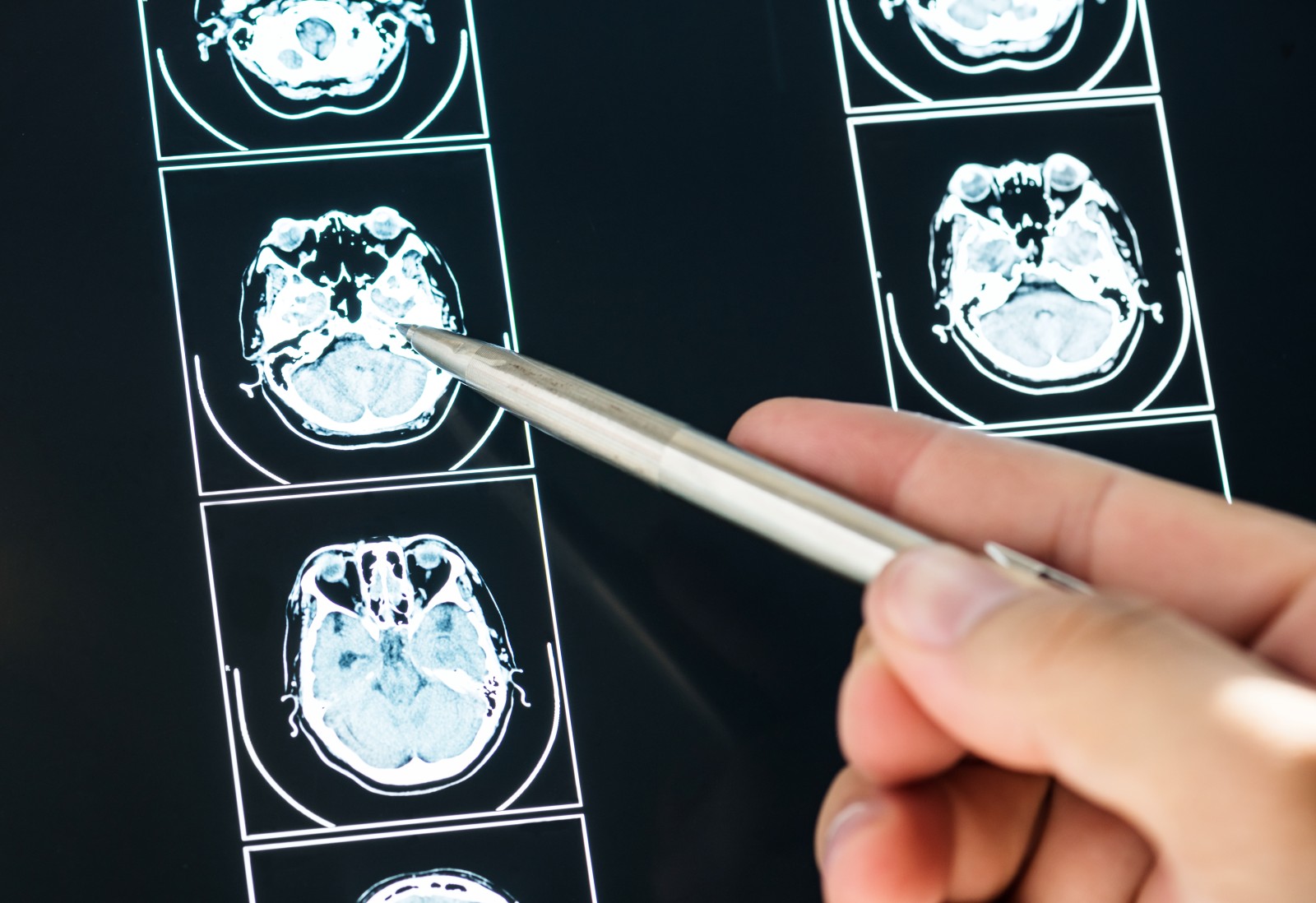Faktor-faktor Penyebab Tumor Otak, Mulai dari Genetik hingga Pengaruh Lingkungan