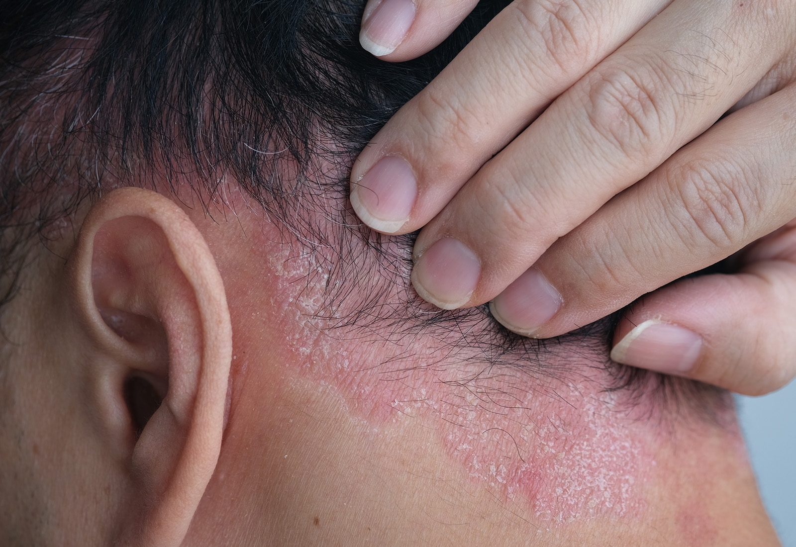 Psoriasis Kulit Kepala, Kenali Gejala dan Pengobatannya