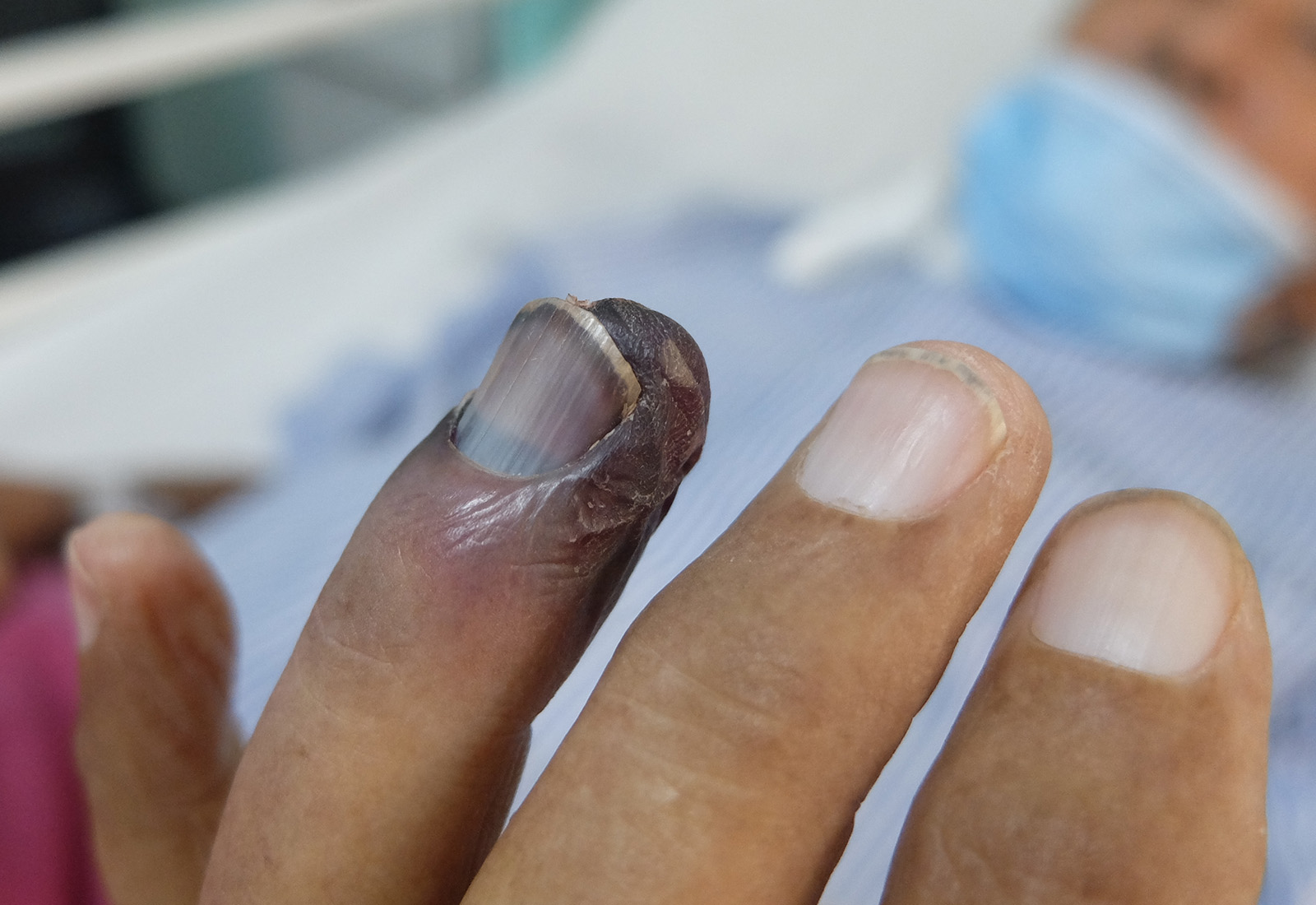 Mengenal Penyakit Buerger, Kondisi yang Harus Diwaspadai oleh Pengguna Tembakau
