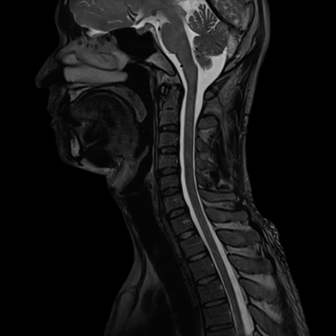 Imatge per ressonància magnètica (MRI) de la columna cervical