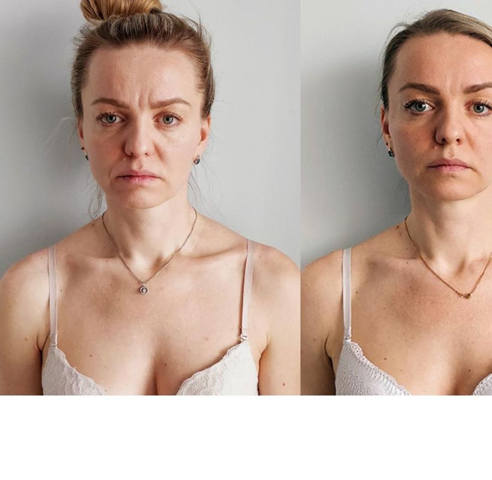 How to remove nasolabial folds in 5 minutes a day
