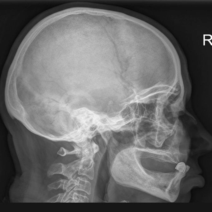 X-ray (การถ่ายภาพรังสี) ของกระดูกขมับ