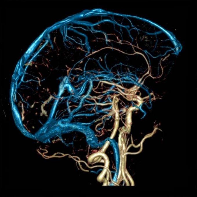 Smegenų kraujagyslių magnetinio rezonanso tomografija (MRT).