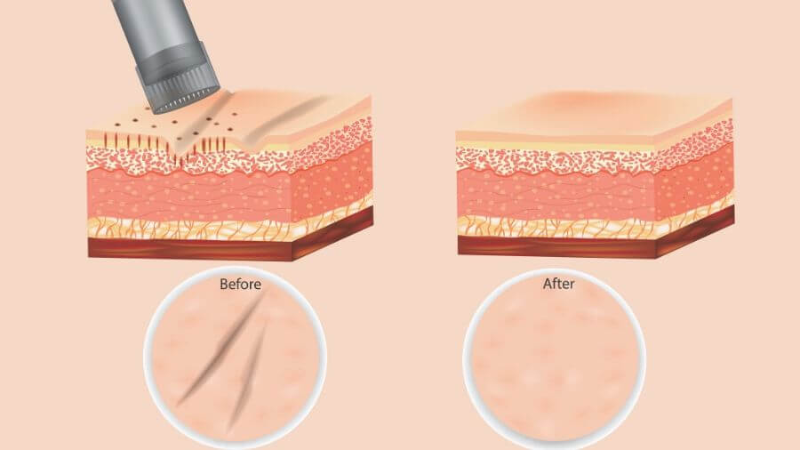 Diagram of skin and micro-needling