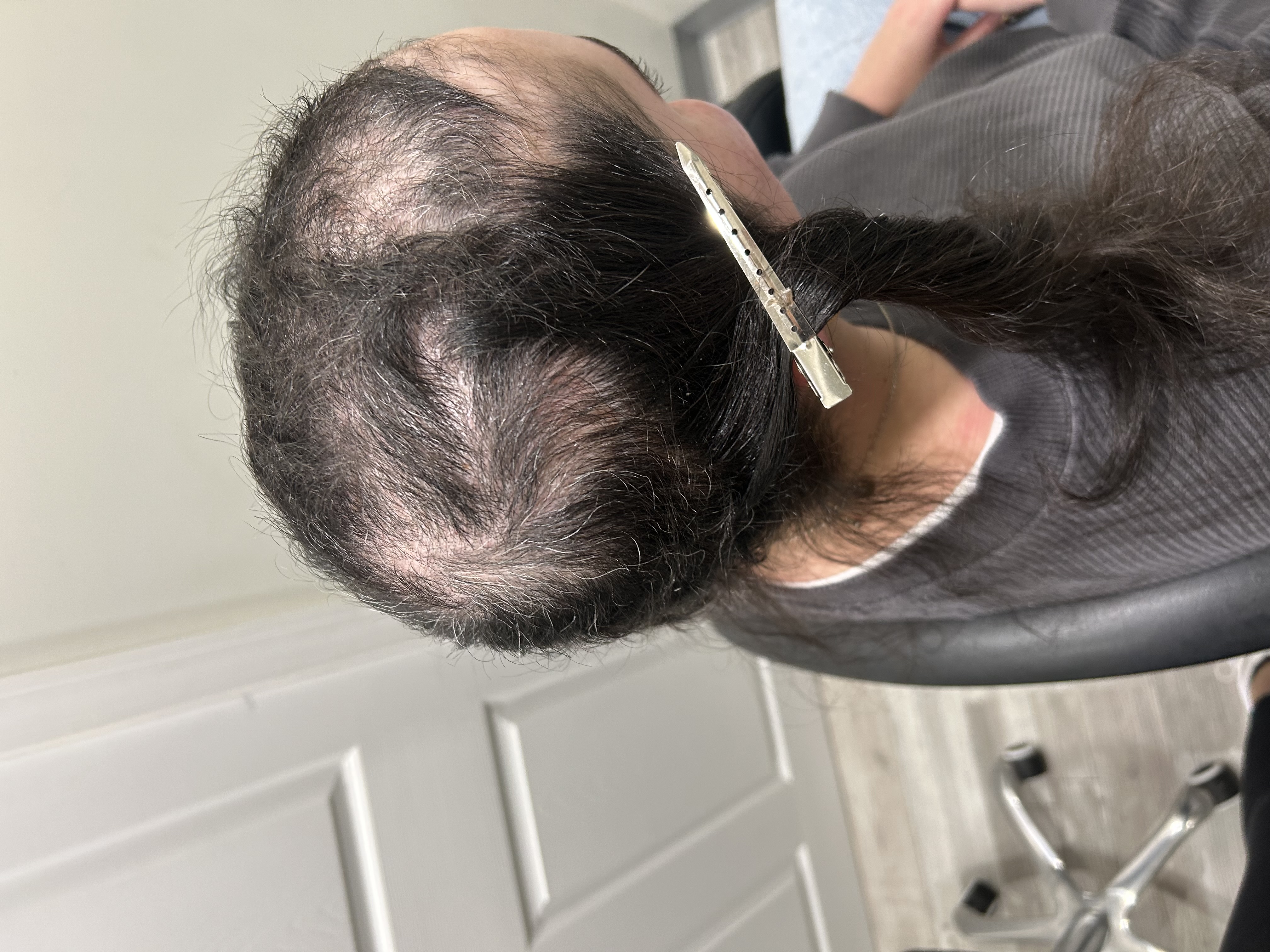 a person with trichotillomania a hair pulling behavior