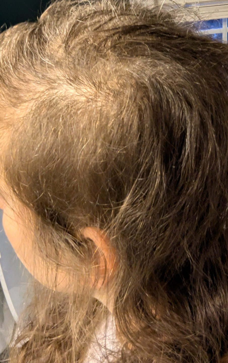 a woman with hair loss due to iron deficiency