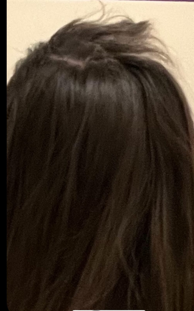 a woman with trichotillomania with hair loss at the top of her head