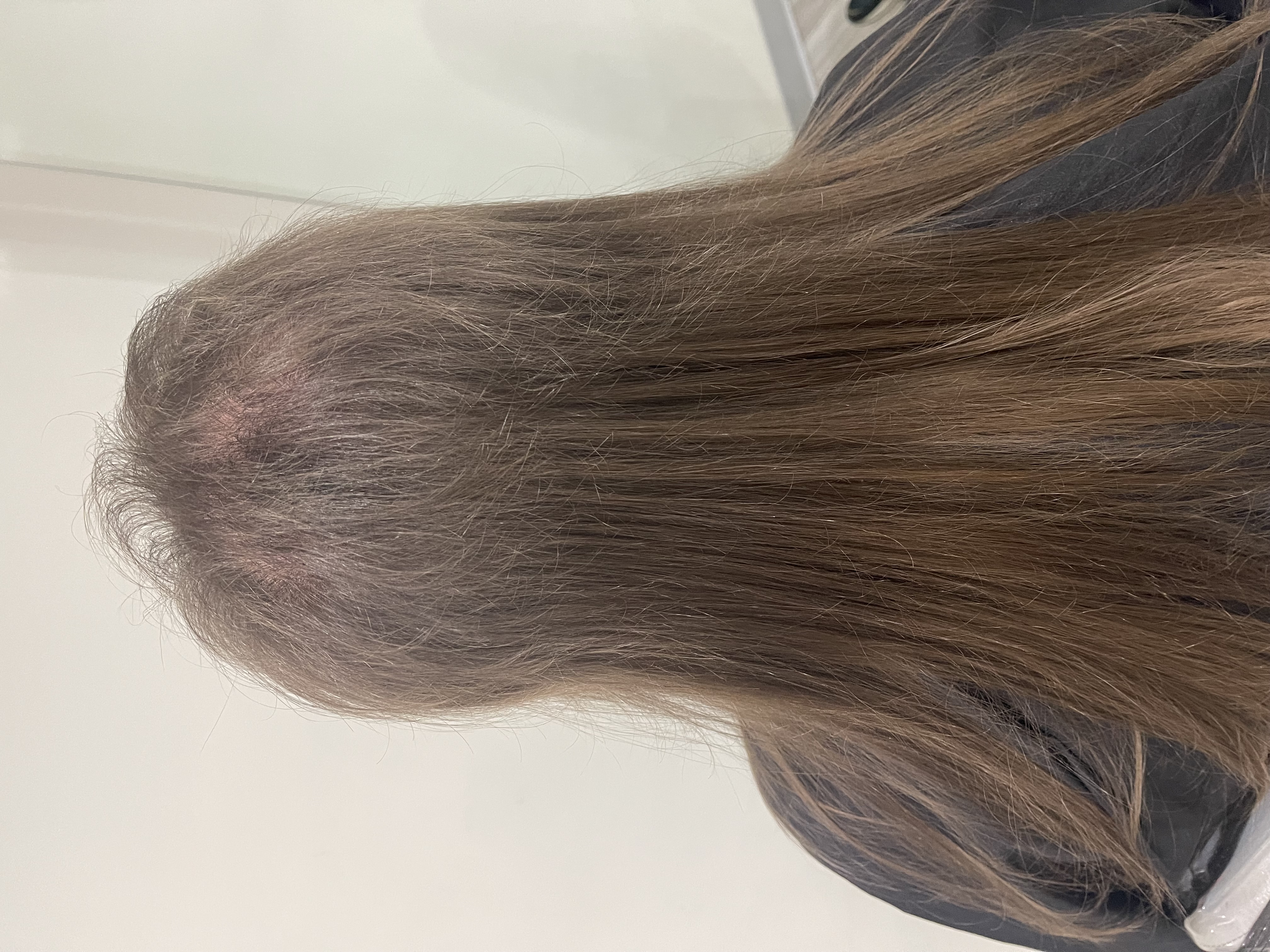 Semaglutide and Hair Loss: Does Semaglutide Cause Hair Loss? Boston, Mass.