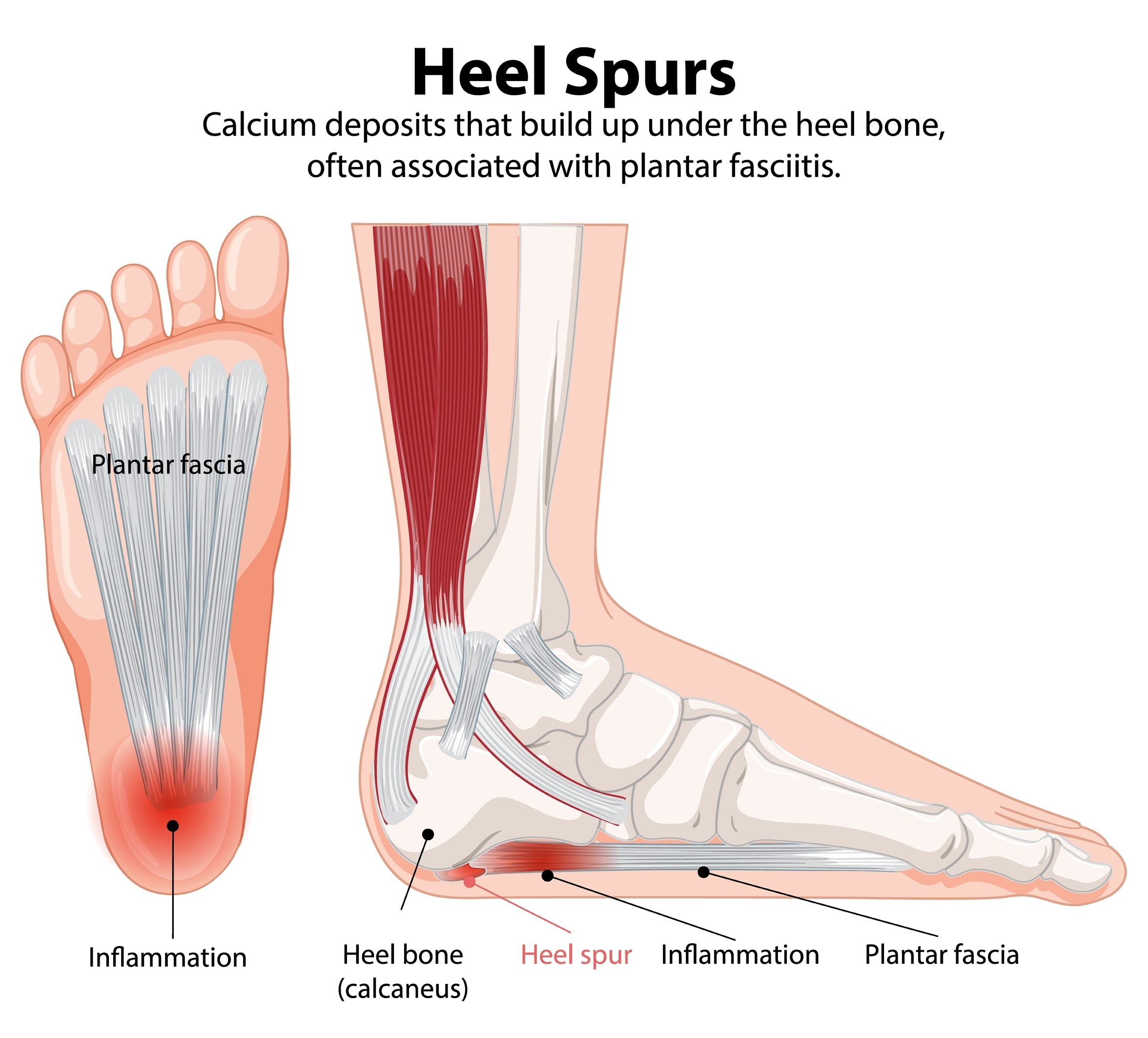 Diagram of a heel spur illustrating a bony growth on the underside of the heel bone (calcaneus). The image highlights the location of the spur, often near the attachment point of the plantar fascia, and its association with plantar fasciitis. Arrows or labels may indicate inflammation, pain points, and surrounding soft tissue structures.