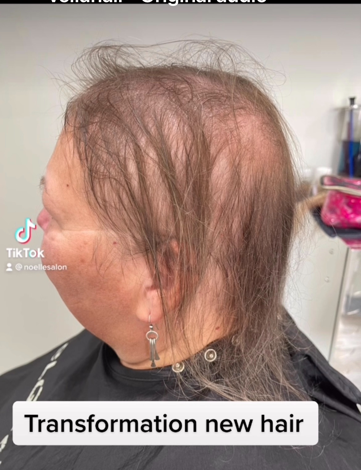 Woman with Alopecia
