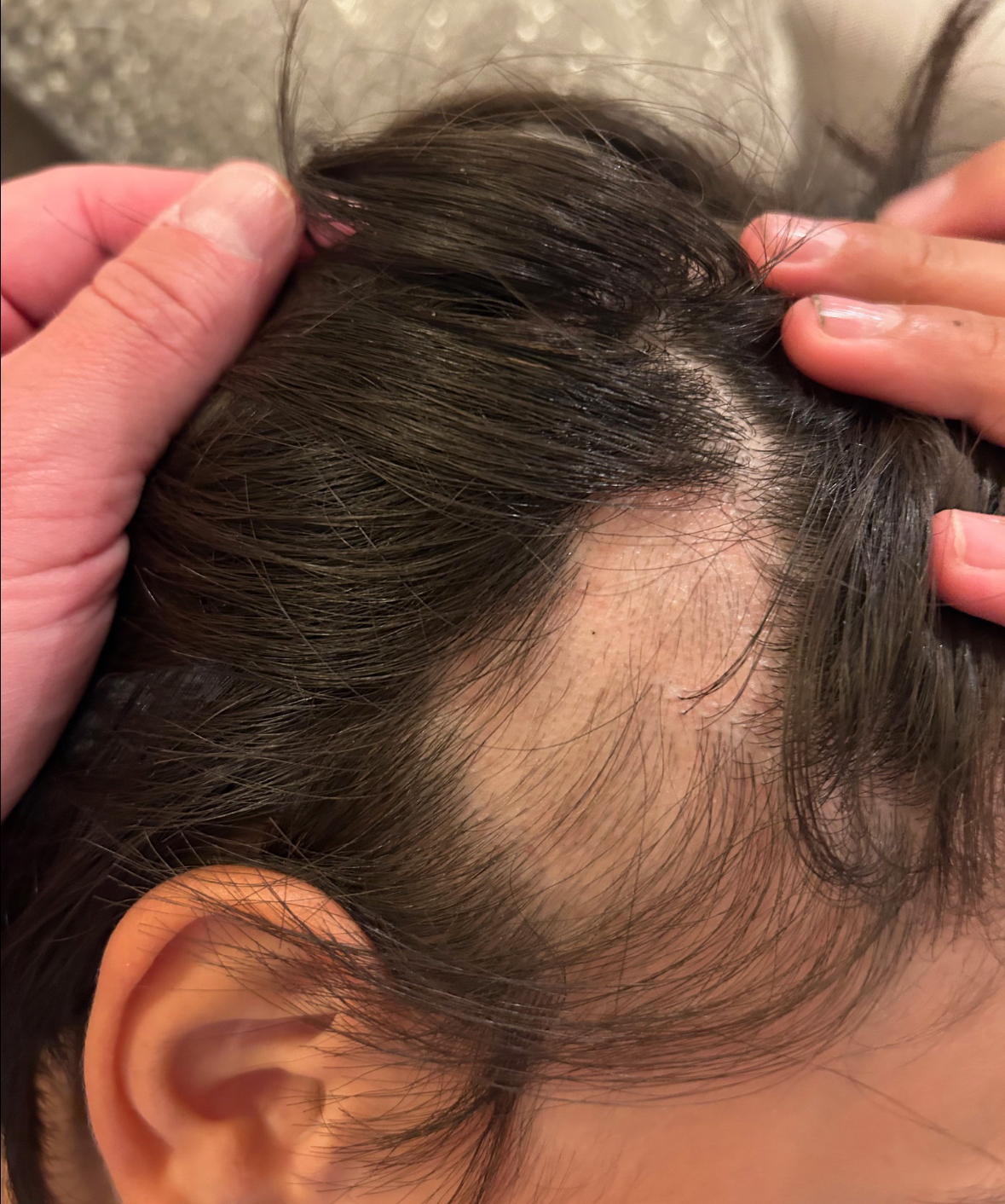 a woman with alopecia areata an autoimmune disearse