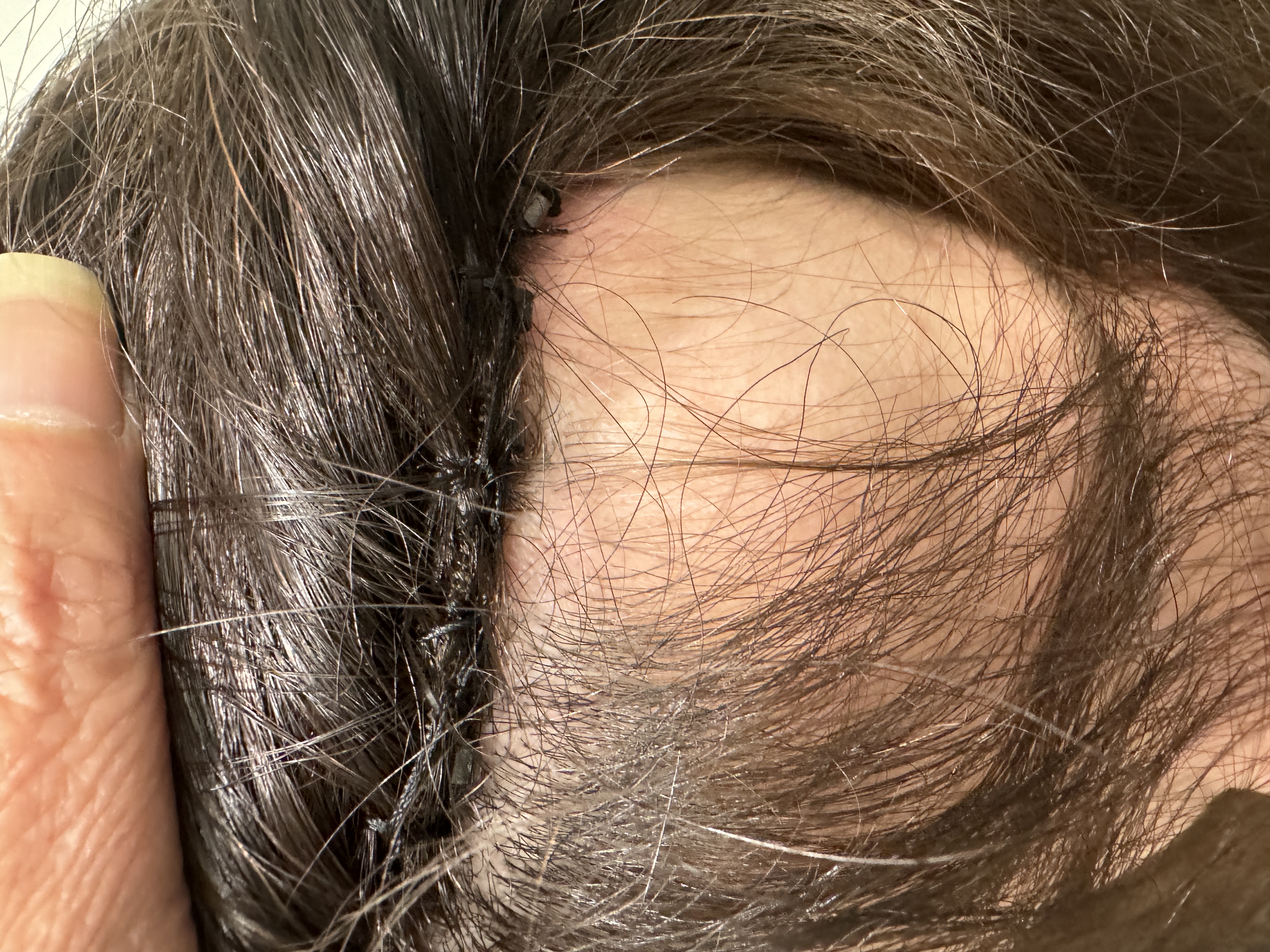 a photo of a woman with trichotillomania wearing a mesh integration hair system