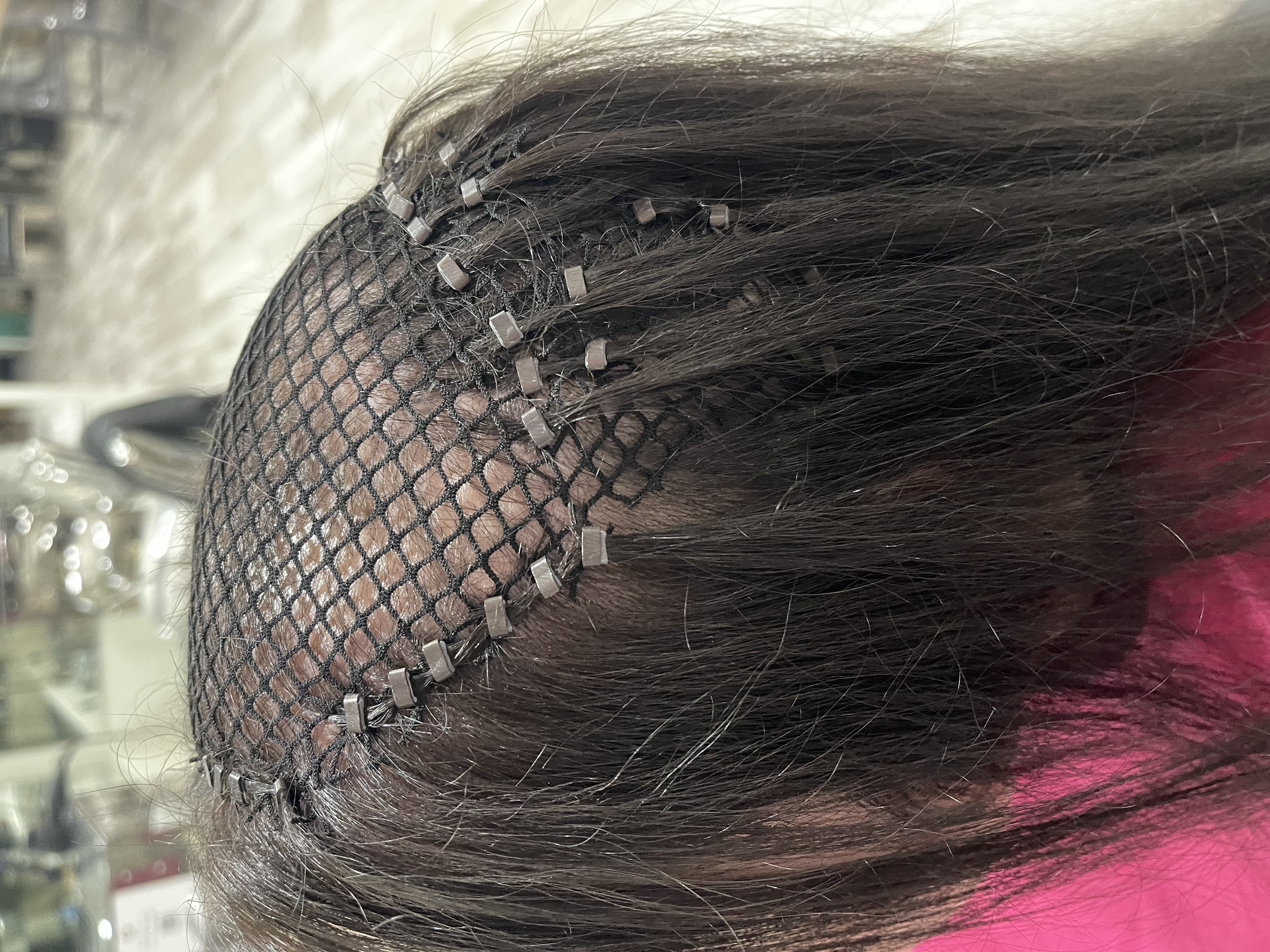 A woman with trichotillomania having a mesh integration applied to help with regrowth