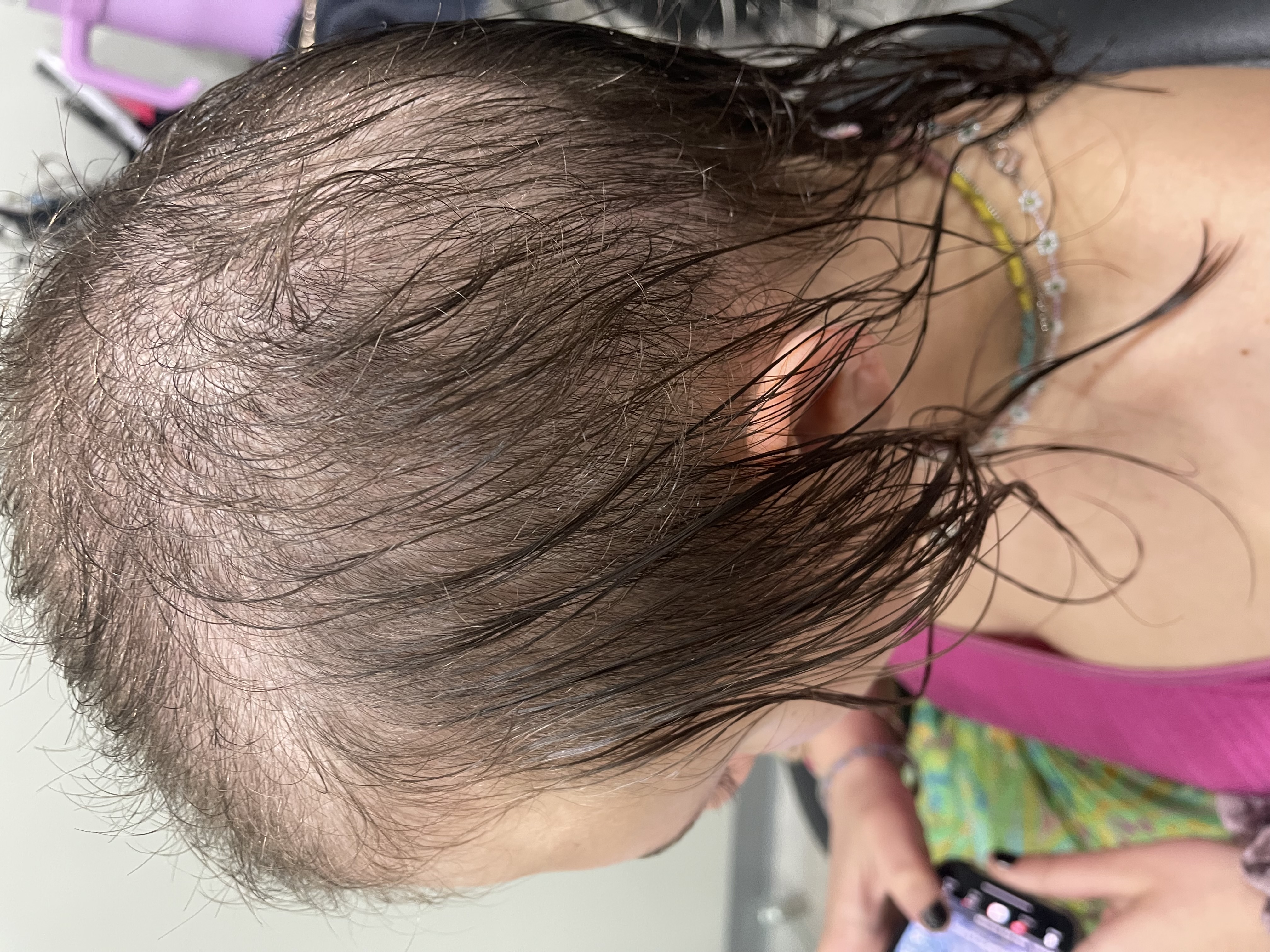 a young woman with trichotillomania