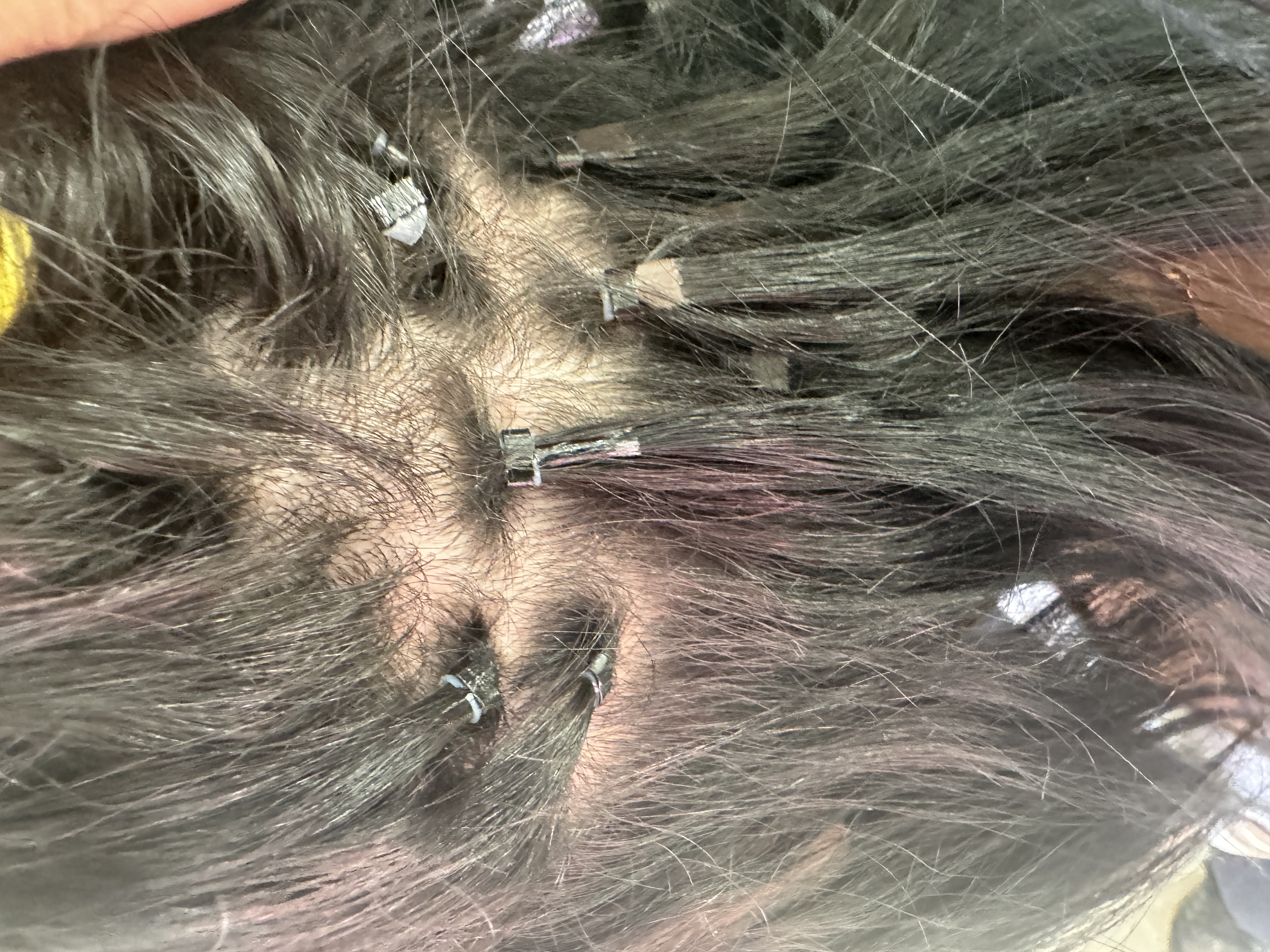 traction alopecia from improperly placed hair extensions