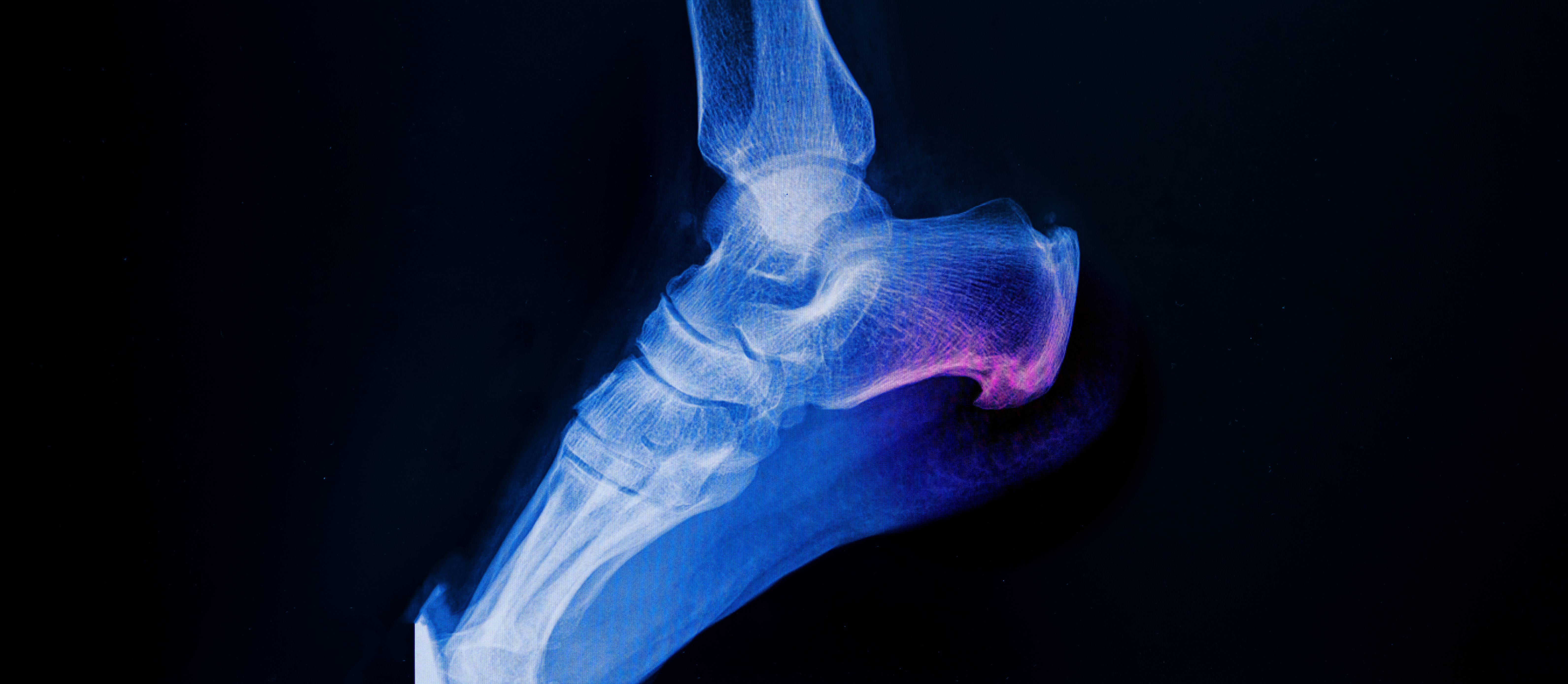 Radiograph (X-ray) image showing a bone spur, a small bony outgrowth, on the edge of a joint. The spur appears as a dense, white projection extending from the bone, commonly found in areas like the heel, knee, or spine.